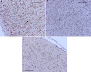 Microfotografías representativas de corteza prefrontal con activación para caspasa-3. A) Rata del grupo O2(1) con una exposición. Nótese la marcación positiva severa en las neuronas corticales B) Rata del grupo sevoflurano1. Obsérvese la marcación positiva moderada en las neuronas de la corteza prefrontal (flecha) C) Rata del grupo sevoflurano2, con la marcación positiva leve en las neuronas (flechas). Barra escala 50μm.