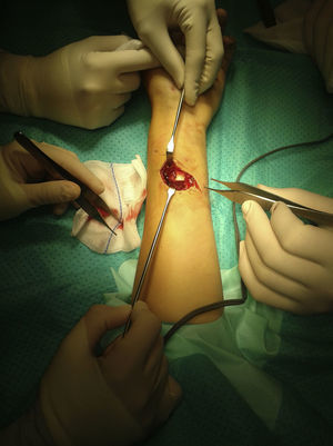 Imagen intraoperatoria de la reparación quirúrgica de las lesiones vasculares y tendinosas en la cara anterior del antebrazo. Fuente: Autores.