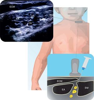 Bloqueo interescalénico. Se ilustra la anatomía de la raíces nerviosas de C5, C6 y C7, laterales al músculo esternocleidomastoideo (ECM) dentro del surco interescalénico (músculo escaleno anterior EA y escaleno medio EM). Fuente: autores.