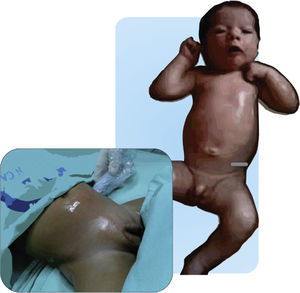 Colocación de la sonda de US en la realización de un bloqueo de plano tranverso de abdomen. Transductor de alta frecuencia a nivel de la línea axilar media a nivel subcostal por encima de la cresta iliaca. Fuente: autores