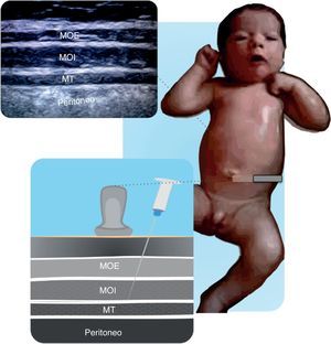 Estructuras anatómicas en un bloqueo de plano transverso de abdomen (TAP). Músculo transverso (MT), oblicuo interno (MOI), y oblicuo externo (MOE). El anestésico local se deposita entre el MT y MOI. Fuente: autores.