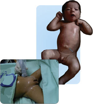 Técnica de colocación del US para el bloqueo de los nervios ilioinguinal e iliohipogástrico (II-IH) sobre la espinal iliaca antero superior y dirigido hacia el ombligo. Fuente: autores.