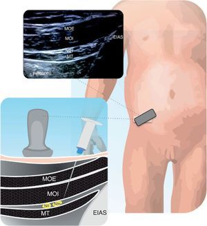 Estructuras anatómicas que se observan en un bloqueo de los nervios ilioinguinal-iliohipogástrico (II-IH). Músculo transverso (MT), oblicuo interno (OI) y oblicuo externo (OE), espina iliaca antero superior (EIAS). El anestésico local se deposita entre el MT y el MOI. Fuente: autores.