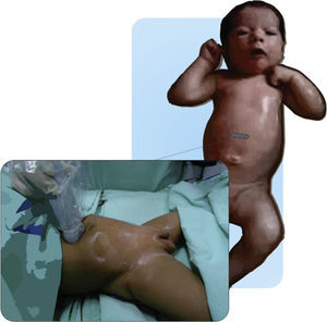 Técnica de colocación del transductor para el bloqueo de la vaina de los rectos.