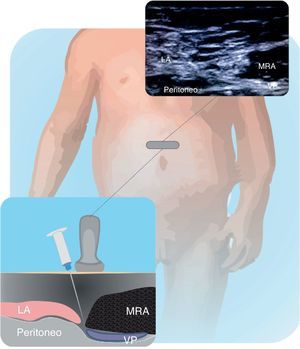 Estructuras observadas en la realización del bloqueo de la vaina de los rectos. La vaina posterior (VP) es el sitio objetivo para depositar el anestésico local. Músculo recto del abdomen (RA); línea alba (LA). Fuente: autores.