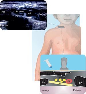 Bloqueo supraclavicular Se muestran las relaciones de los troncos y sus divisiones de la arteria subclavia (AS), pulmón y primera costilla (PC). Escaleno medio (EM); escaleno anterior (EA). Fuente: autores.