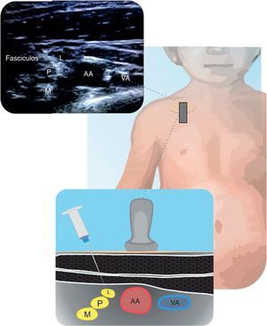 Bloqueo infraclavicular Se muestran los fascículos (L: lateral; P: posterior y M: medial) y su relación con la arteria axilar (AA) y la vena axilar (VA). Fuente: autores