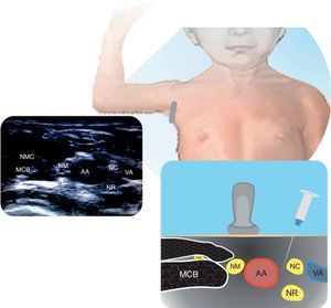 Bloqueo axilar Se muestra la arteria axilar (AA) en relación con los nervios músculos cutáneos (NMC), nervio mediano (NM), nervio cubital (NC) y nervio radial (NR), músculo córaco-braquial (MCB), y vena axilar (VA). Fuente: autores