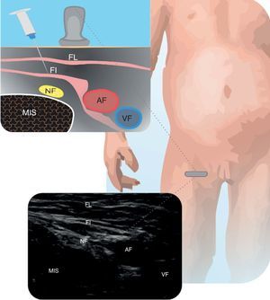 Nervio femoral Se muestra el nervio femoral (NF) y su relación con la arteria femoral (AF) y vena femoral (VF), fascia lata (FL), fascia ilíaca (FI), y músculo iliopsoas (MIAS). Fuente: autores
