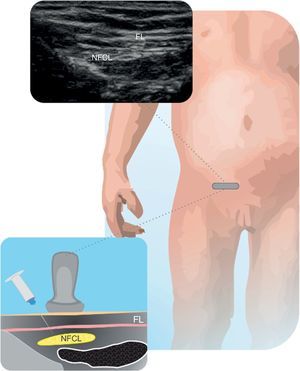 Nervio fémoro cutáneo lateral (NFCL) Se muestra el NFCL y sus relaciones anatómicas. Fascia lata (FL). Fuente: autores