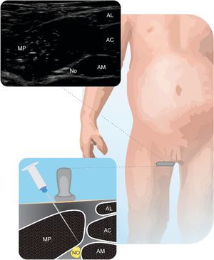 Nervio obturador (NO) Se muestra el NO antes de dividirse en relación con los músculos aductores. Aductor largo (AL), aductor corto (AC), aductor magno (AM), y músculo pectíneo (MP). Fuente: autores