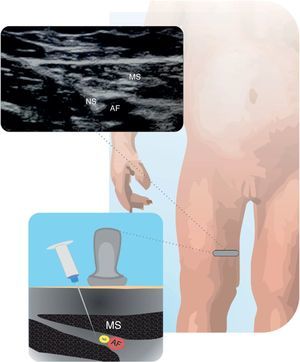 Nervio safeno (NS) Se muestra el NS en relación con la arteria femoral (AF) y al músculo sartorio (MS) en el tercio distal del muslo. Fuente: autores