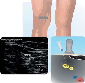 Nervio ciático poplíteo (NCP) Se muestra el NCP al momento de la unión de sus 2 componentes: nervio tibial (NT) y nervio peronéo común (NPC). Arteria poplítea (AP). Fuente: autores