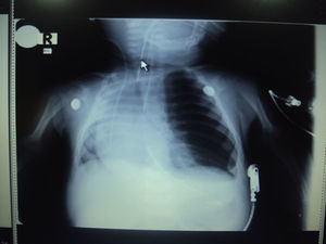 Radiografía de tórax del paciente, antes de ser llevado a cirugía. Fuente: autores.