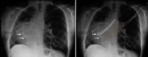 Signo de cimitarra en la radiografía pulmonar. Fuente: autores.