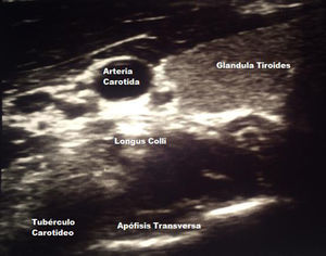 Imagen de ecografía donde se observa la arteria carótida a nivel superior; medial a esta la glándula tiroides; debajo de la arteria carótida se encuentra el músculo longus colli y en la parte más inferior se identificará la apófisis transversa de C6 que es reconocida por su tubérculo anterior. Fuente: autor.