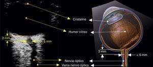 Visualización de la vaina del nervio óptico. Diámetro normal. Fuente: autores.