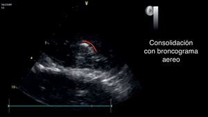 Área de consolidación basal con área hiperecogénica visible durante el examen, se resalta en rojo el trayecto del broncograma aéreo. Fuente: autores.