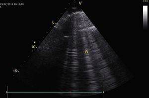 El síndrome intersticial está caracterizado por presencia de deslizamiento pleural y artefactos B. Observe la presencia de más de 3 líneas verticales (B) que inician en la pleura hasta el fondo de la pantalla relacionado con edema pulmonar. Fuente: autores.