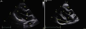 Ventana paraesternal eje largo. A) Normal. B) Derrame pericárdico severo (flechas). AD: aorta torácica descendente; AI: aurícula izquierda; PP: pericardio posterior; VA: válvula aórtica; VD: ventrículo derecho; VI: ventrículo izquierdo. Fuente: autores.
