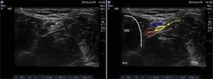 Imagen por ultrasonido del nervio tibial. ATP: arteria tibial posterior; MM: maléolo medial; NTP: nervio tibial posterior; TFLH: tendón flexor largo del hallux. Fuente: autores.
