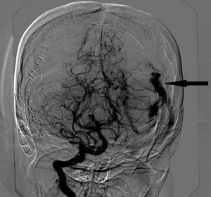 Angiografía cerebral a través de la arteria carótida interna en la cual se aprecia una malformación arteriovenosa izquierda (flecha). Fuente: autores.