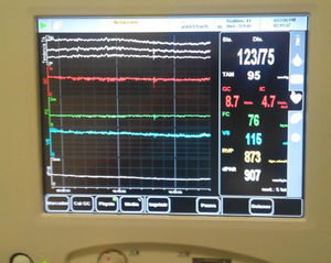 Imagen del monitor de gasto cardiaco no invasivo donde se muestran los distintos parámetros hemodinámicos intraoperatorios. Fuente: autores.