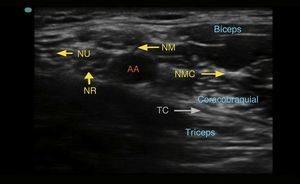 Imagen ecográfica del plexo braquial a nivel axilar. AA: arteria axilar; NM: nervio mediano; NMC: nervio musculocutáneo; NR: nervio radial, TC: tendón conjunto; NU: nervio ulnar.