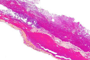 Hematoma subdural visto con microscopia óptica donde se puede observar el plano de separación del neuroepitelio. Tomada de Nephron (https://goo.gl/DDG616). Reproducido con autorización.