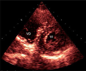 Moderada dilatación del ventrículo derecho. VD: ventrículo derecho; VI: ventrículo izquierdo. Fuente: autores.