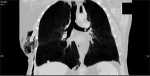 Tomografía computarizada en la que aparece un cuerpo extraño a 3,8mm de la carina en una imagen redonda de cerca de 5mm que ocupa el bronquio fuente izquierdo generando atelectasia del lóbulo superior izquierdo. Se observó un neumotórax derecho mínimo.
