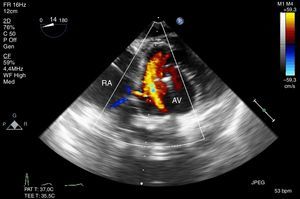 Proyección transgástrica profunda que muestra la válvula aórtica y la aurícula derecha. La CFD muestra el flujo a través del defecto del tabique. Fuente: autores.