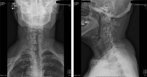 Radiografía de la columna cervical. Fuente: autores.