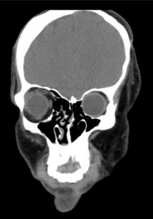 Imagen de tomografía axial computarizada que muestra la asimetría del macizo craneofacial.