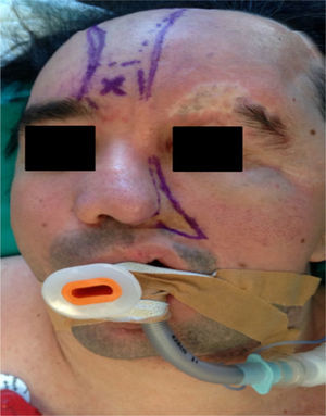 Imagen frontal del paciente que muestra la hemiatrofia facial izquierda, placa de atrofia en la ceja izquierda, contracción del globo ocular, prótesis ocular izquierda. Líneas de demarcación del colgajo frontonasal.