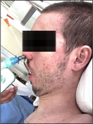 Paciente con intubación nasotraqueal. Fuente: autores.