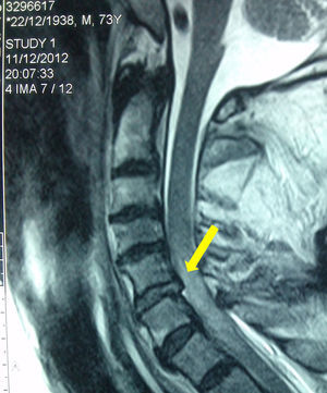 RM sagital de columna cervical de caso 2. Herniación traumática de disco C5-6 (flecha). Fuente: autores.