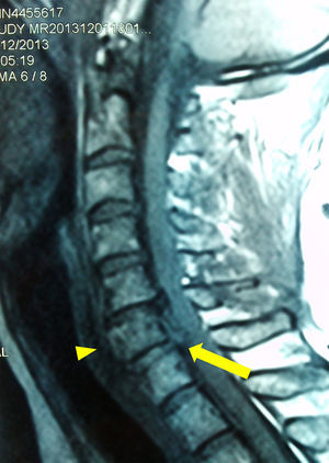 RM sagital de columna cervical de caso 3. Herniación traumática de disco C6-7 (flecha) y desplazamiento anterior de cuerpo de C6 (punta de flecha). Fuente: autores.