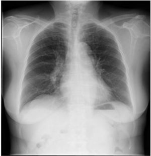 Radiografía de tórax en el día postoperatorio 5. Las líneas intersticiales bilaterales en los rayos X del tórax desaparecieron. Fuente: autor.