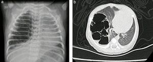a y b) Radiografía de tórax y tomografía axial computarizada de tórax prequirúrgica. Caso n.° 1. Fuente: autores.