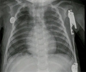 Radiografía de tórax control en el postoperatorio. Caso n.° 1. Fuente: autores.