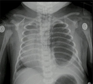 Radiografía de tórax prequirúrgica. Caso n.° 2. Fuente: autores.