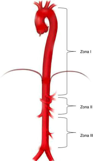 Zonas de oclusión aórtica. La zonaiii inicia en la bifurcación de las iliacas y va hasta la arteria renal más inferior. La zonaii va desde la arteria renal más inferior hasta el tronco celiaco. La zonai se extiende desde la subclavia izquierda hasta el tronco celiaco. Fuente: Autores.