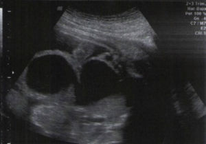 Ecografia obstétrica. Corte coronal del feto, en el que se observa una imagen quística de pared gruesa, comunicada con lo que pareciera corresponder a la vejiga; se sospecha megauréter y megavejiga. Nótese el líquido libre en cavidad abdominal. En la evaluación retrospectiva, las imágenes quísticas observadas probablemente correspondían al cuello uterino (a la derecha de la imagen) y al útero (a la izquierda), distendidos por material mucoide.