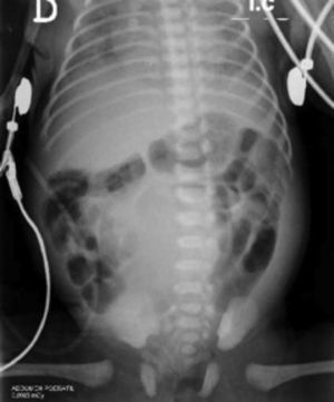 Radiografía de abdomen simple, proyección AP. Se observa opacidad en el mesogastrio y el hipogastrio, con desplazamiento de las asas intestinales hacia la periferia, hallazgo indicativo de masa intraabdominal.