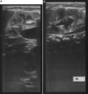 Ecografía renal y de vías urinarias. A y B: Cortes longitudinales del riñón derecho (A) e izquierdo (B), que muestran ureterohidronefrosis, de grado III en el derecho y de grado II en el izquierdo, y aumento difuso de la ecogenicidad renal bilateral.