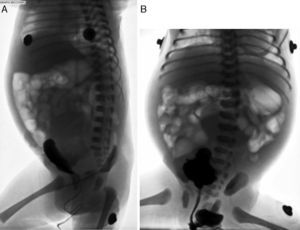 Cistouretrografía miccional. A. Proyección lateral en la que se observa la vejiga con medio de contraste, rechazada hacia Adelante por una masa densa no dependiente ni relacionada con las vías urinarias. B. Proyección anteroposterior durante la micción, en la cual se descartan reflujo vésico-ureteral y valvas uretrales.