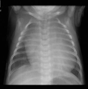 Radiografia de Tórax con Cardiomegalia.