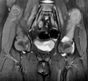 Resonancia magnética de pelvis. En secciones coronales de los huesos de la cadera derecha (1) y los tejidos blandos no se muestra cambios. Lesión neoplásica primaria en hueso ilíaco izquierdo (2).