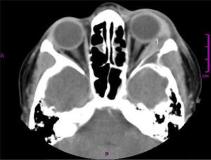 TC axial de cráneo con contraste. Reporta lesión de 3×1cm, bien definida en cara superior de la órbita izquierda con realce de contraste, se evidencia destrucción ósea (1).